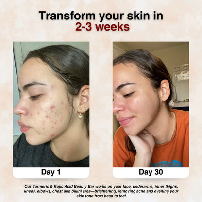 Turmeric & Kojic Acid - Skin Brightening Soap